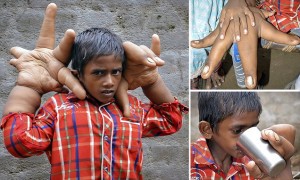 Child With Giant Hands Baffles Doctors