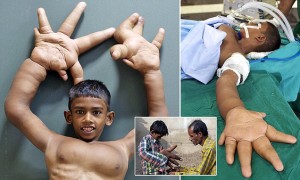 Child With Giant Hands Baffles Doctors